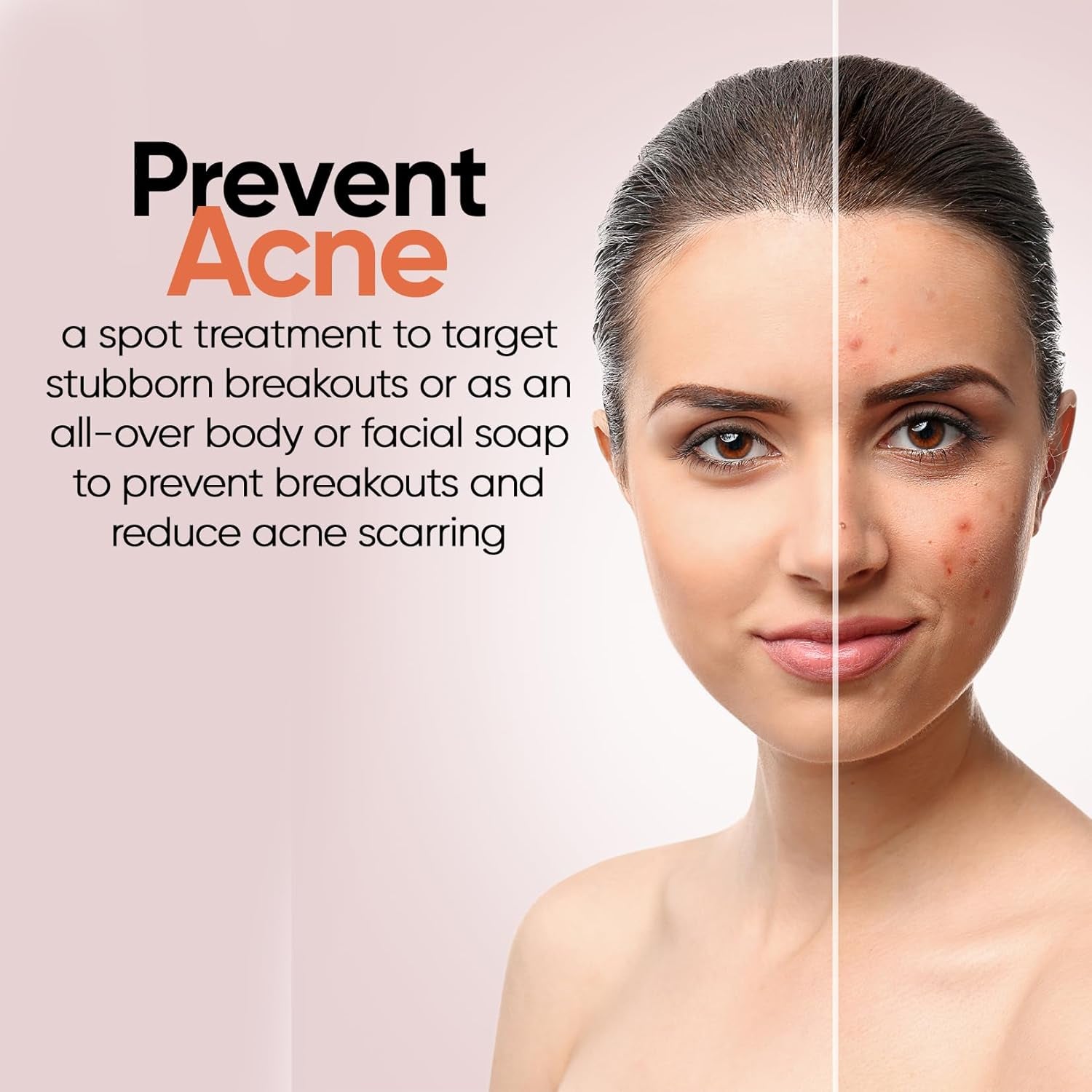 Acne Charcoal Soap - For Face and Body
